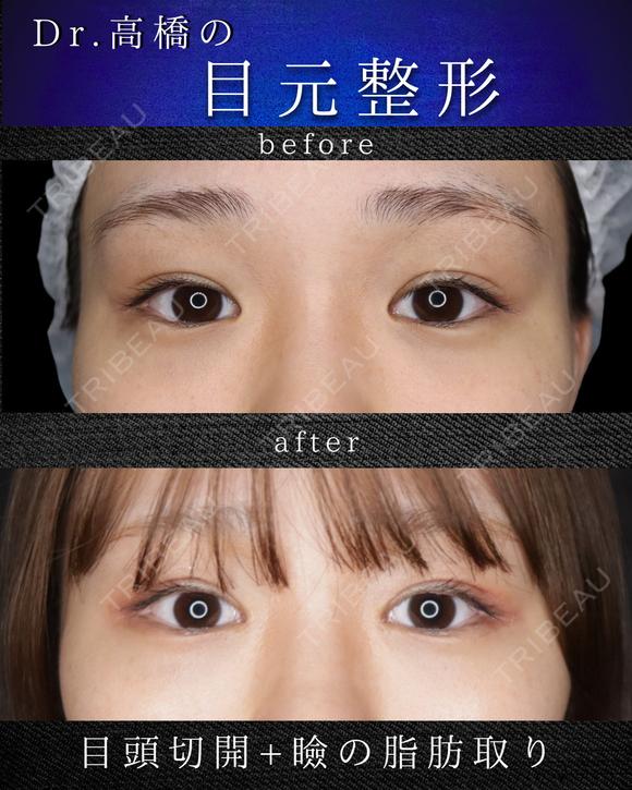 目頭切開・瞼の脂肪取り after画像 メイン用