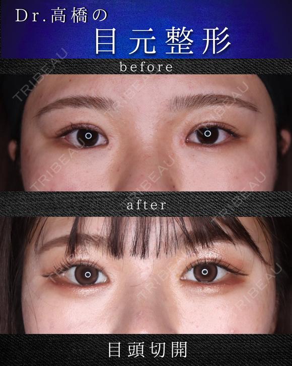 目頭切開 after画像 メイン用