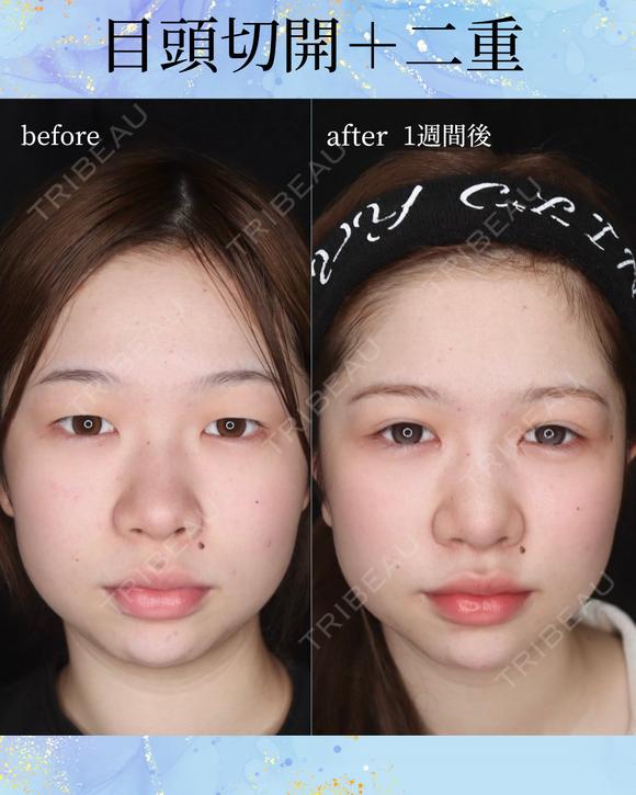 目頭切開・二重埋没法(自然癒着法) after画像 メイン用