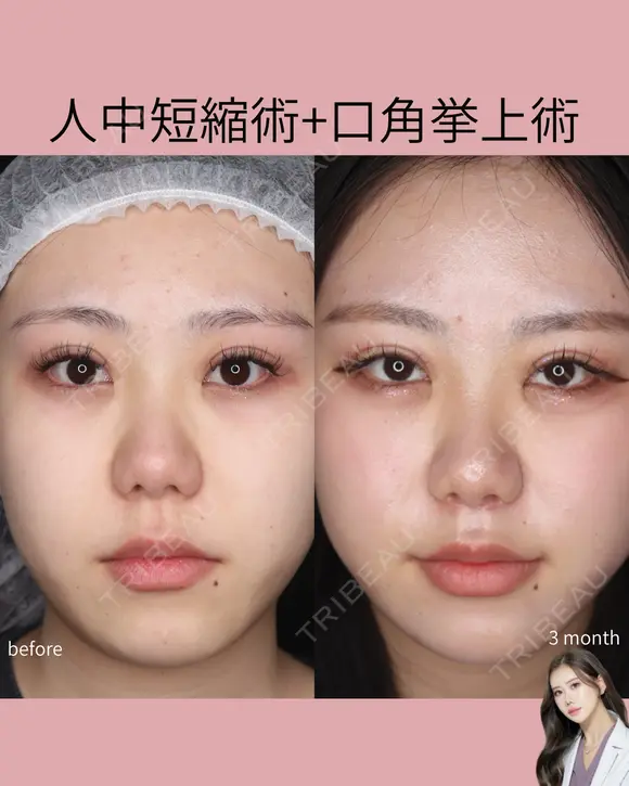 人中短縮術・口角挙上術 before画像 メイン用