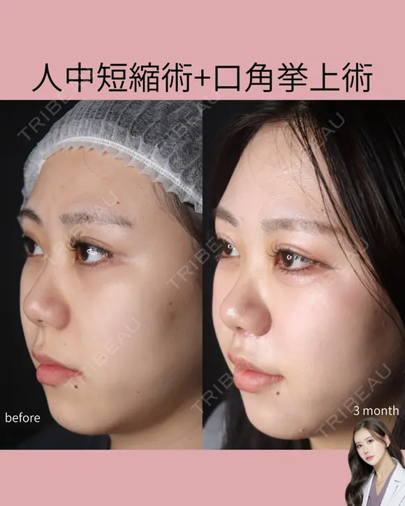 人中短縮術・口角挙上術 after画像 メイン用