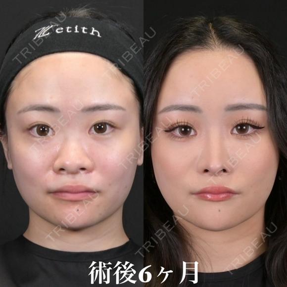 術後6ヶ月 北村医師とコラボオペ before画像 メイン用