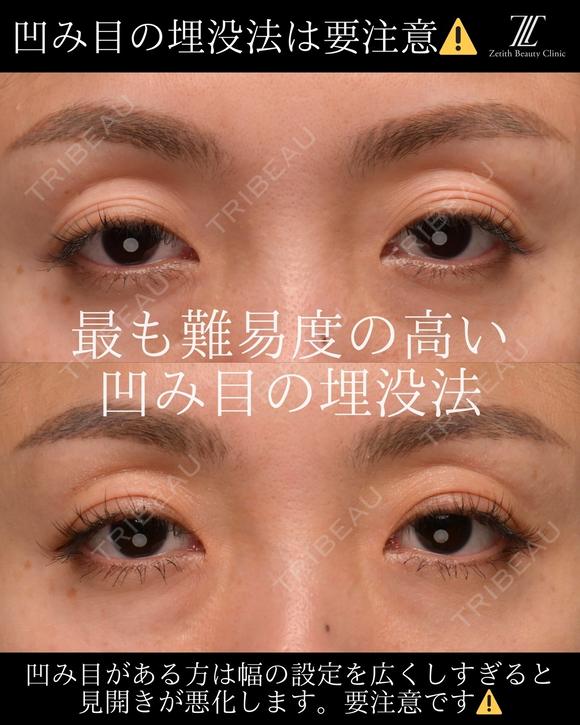 『凹み目に対する埋没法の見解』 0日後 メイン用