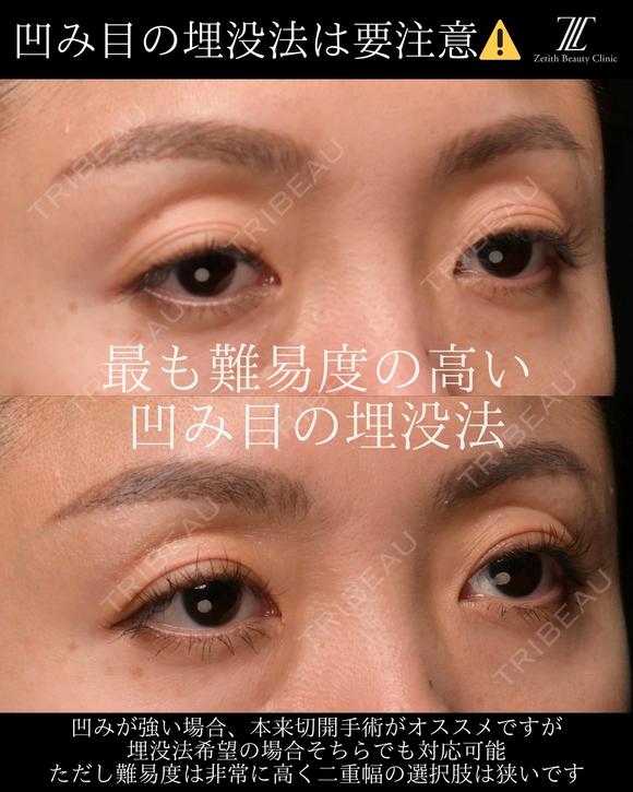 『凹み目に対する埋没法の見解』 0日後 メイン用