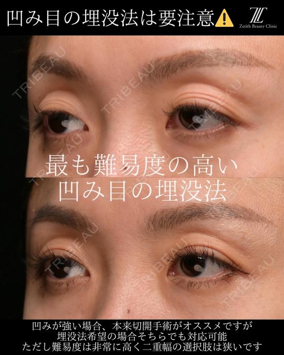 『凹み目に対する埋没法の見解』 0日後 メイン用