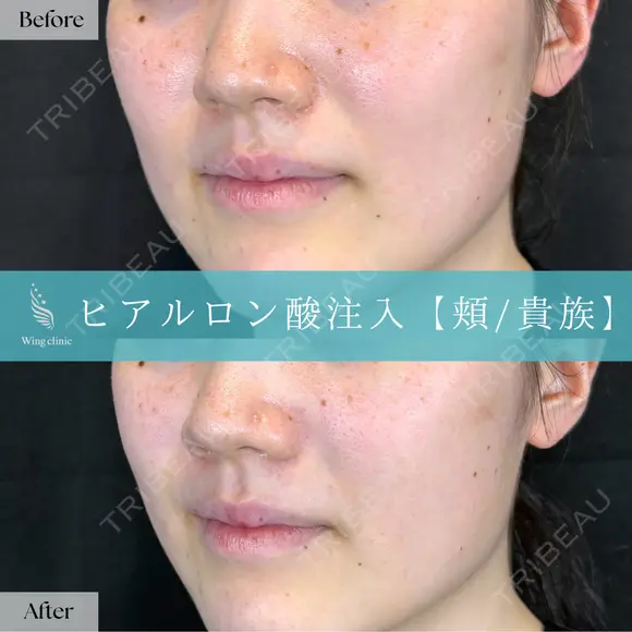 Wing式 頬・貴族ヒアルロン酸形成 before画像 メイン用