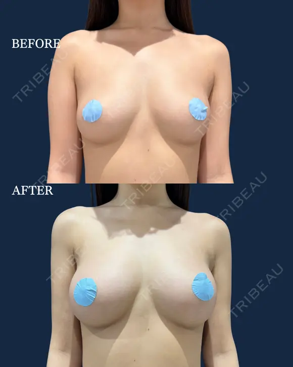 脂肪豊胸 before画像 メイン用
