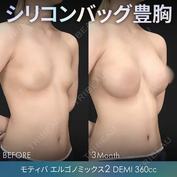 シリコンバッグ豊胸モティバ（モティバエルゴノミックス2 DEMI 360cc×左右） 90日後 メイン用