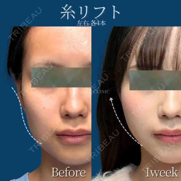 糸リフト　8本 after画像 メイン用