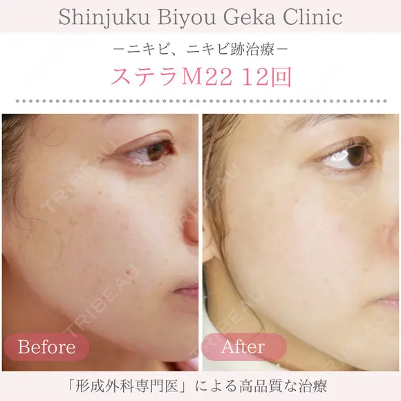 フォトフェイシャル ステラM22 after画像 メイン用