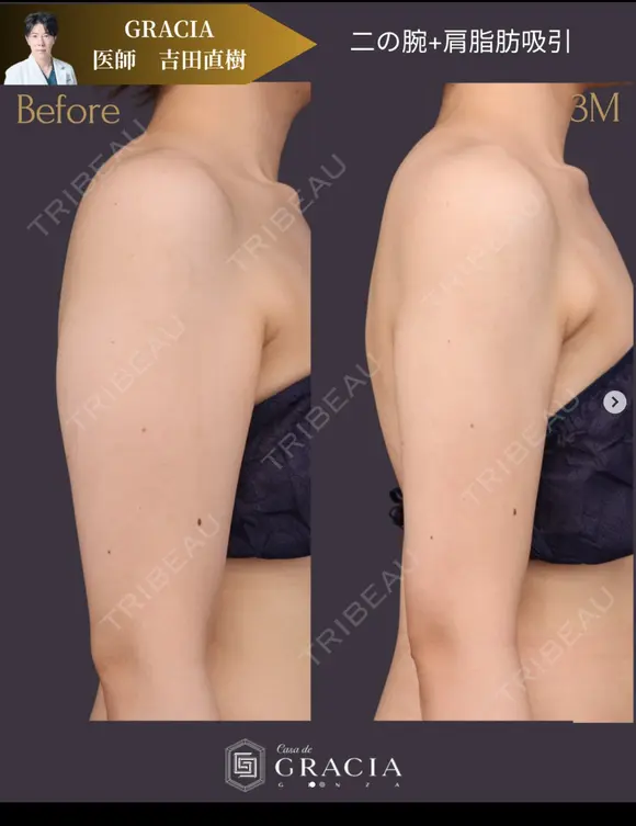 ベイザー二の腕＋肩脂肪吸引 before画像 メイン用