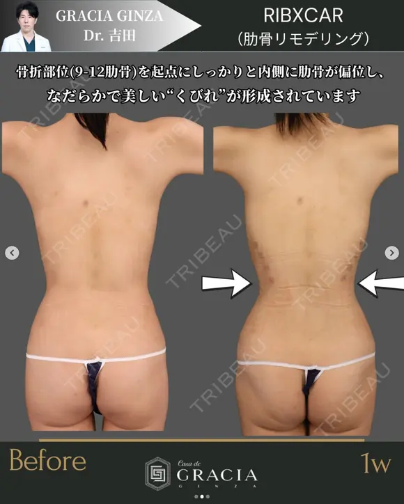 肋骨リモデリング after画像 メイン用
