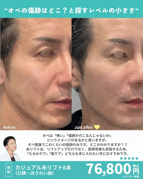 カジュアル糸リフト8本（口横・ほうれい線） before画像 メイン用