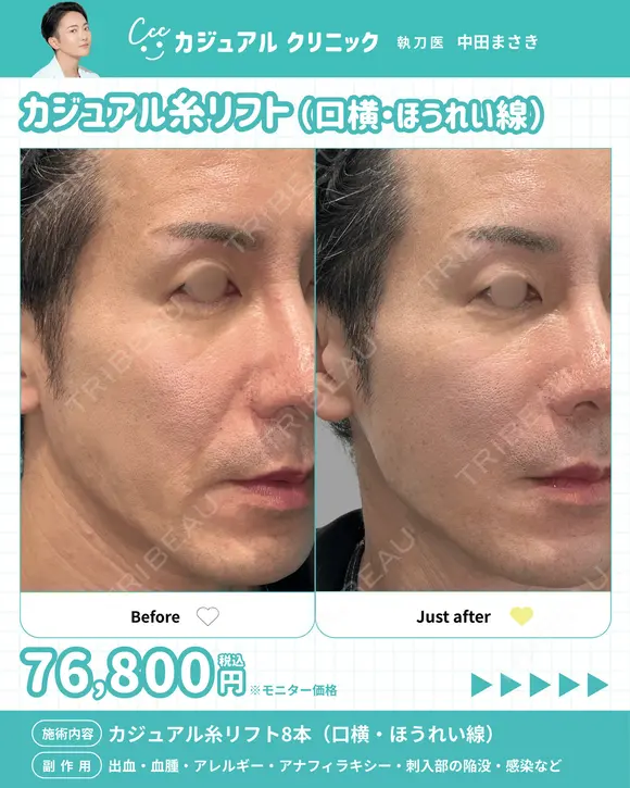 カジュアル糸リフト8本（口横・ほうれい線） after画像 メイン用