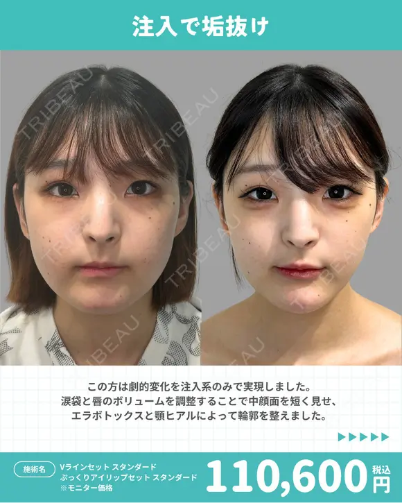 Vラインセット＋ぷっくりアイリップセット before画像 メイン用