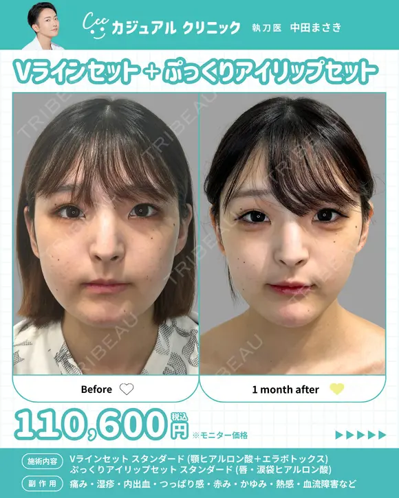 Vラインセット＋ぷっくりアイリップセット 30日後 メイン用