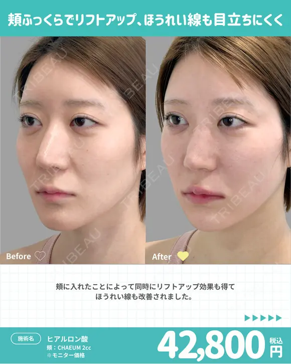 頬 ヒアルロン酸 before画像 メイン用