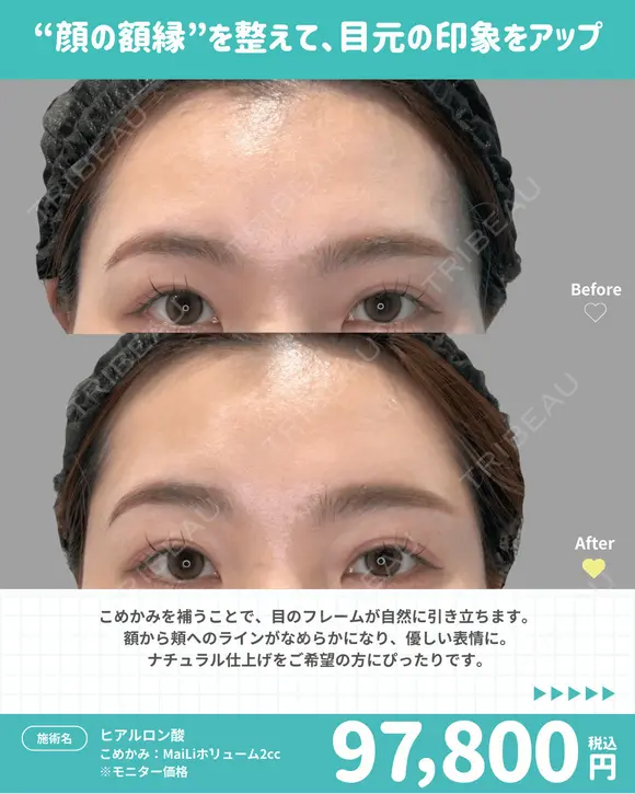 こめかみヒアルロン酸 before画像 メイン用