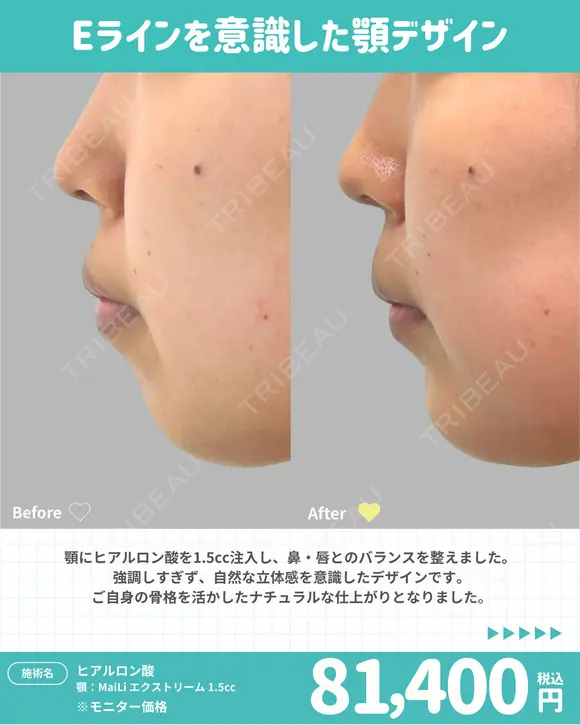 顎 ヒアルロン酸 before画像 メイン用
