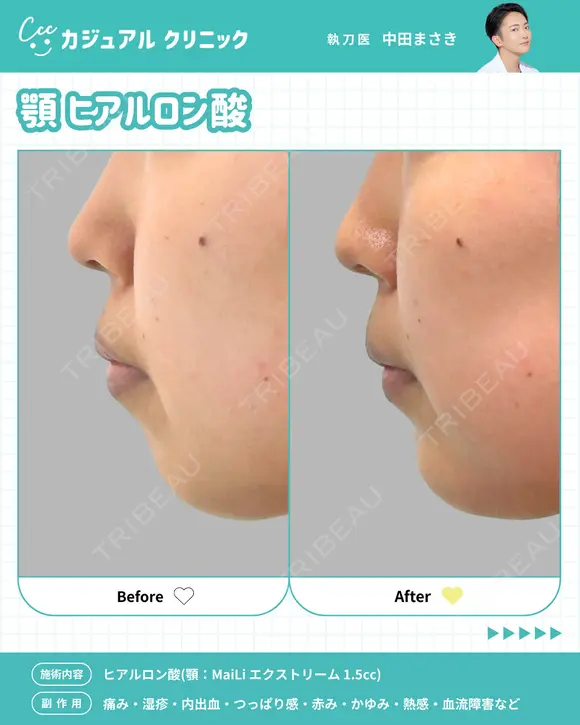 顎 ヒアルロン酸 after画像 メイン用