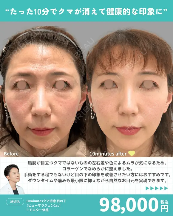 10minutesクマ治療 目の下 (ベビーコラーゲン1cc) before画像 メイン用