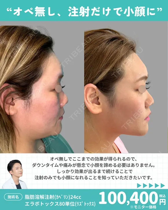 脂肪溶解注射(ｶﾍﾞﾘﾝ)24cc/エラボトックス80単位(ﾘｽﾞﾄｯｸｽ) before画像 メイン用
