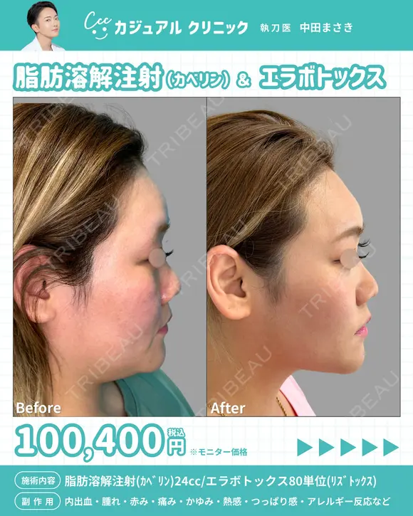 脂肪溶解注射(ｶﾍﾞﾘﾝ)24cc/エラボトックス80単位(ﾘｽﾞﾄｯｸｽ) 30日後 メイン用