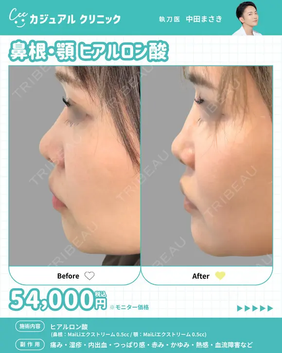 鼻根・顎ヒアルロン酸 after画像 メイン用