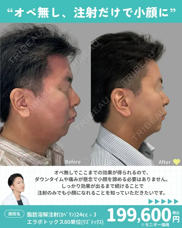 脂肪溶解注射(ｶﾍﾞﾘﾝ)24cc×3回/エラボトックス80単位(ﾘｽﾞﾄｯｸｽ) before画像 メイン用