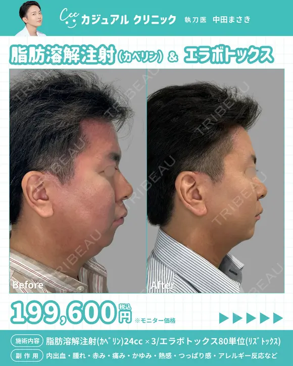 脂肪溶解注射(ｶﾍﾞﾘﾝ)24cc×3回/エラボトックス80単位(ﾘｽﾞﾄｯｸｽ) after画像 メイン用