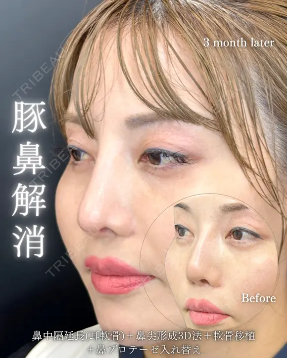 鼻フル整形 after画像 メイン用