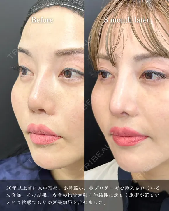 鼻フル整形 before画像 メイン用
