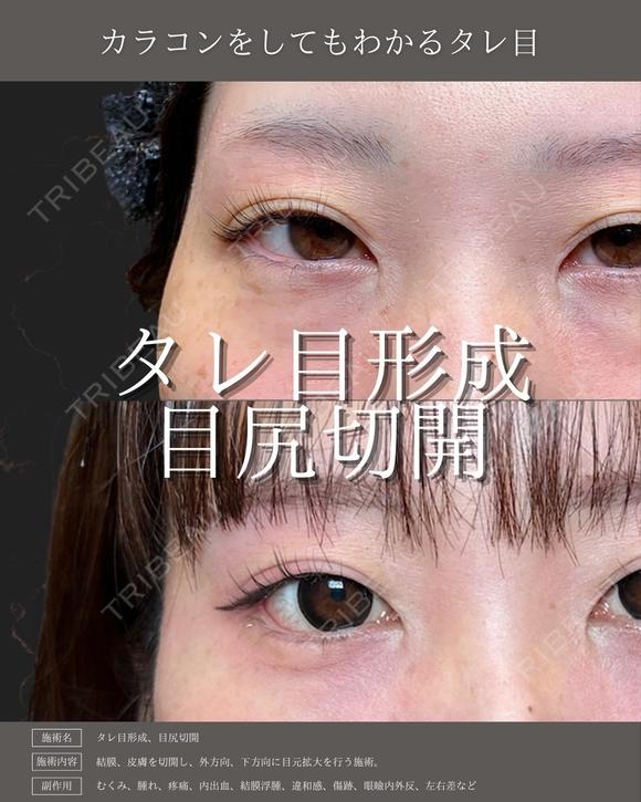 【タレ目形成】目尻切開＋タレ目形成 before画像 メイン用