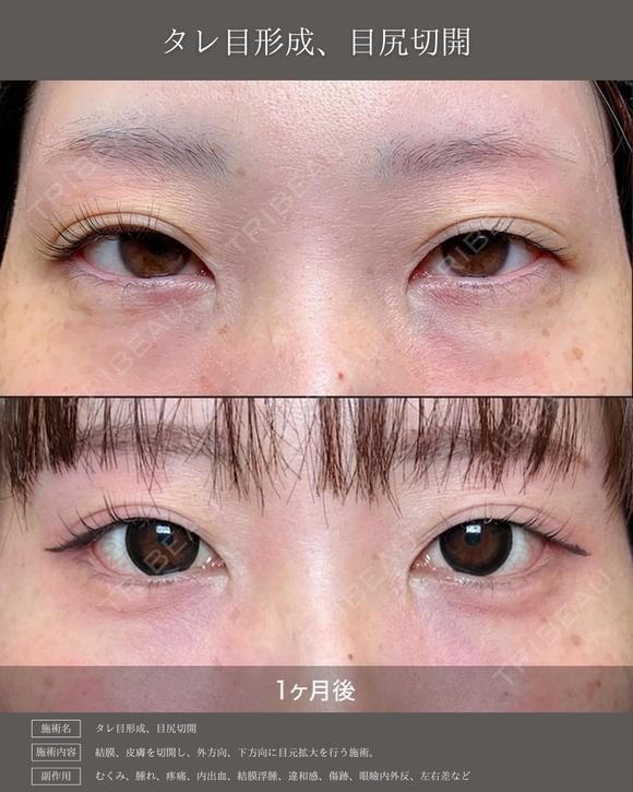【タレ目形成】目尻切開＋タレ目形成 after画像 メイン用