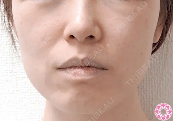 エラ取り（ボトックス） before画像 メイン用
