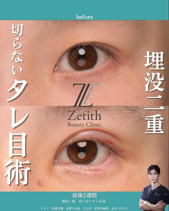 埋没二重と切らないタレ目術を受けられた方です。 14日後 メイン用
