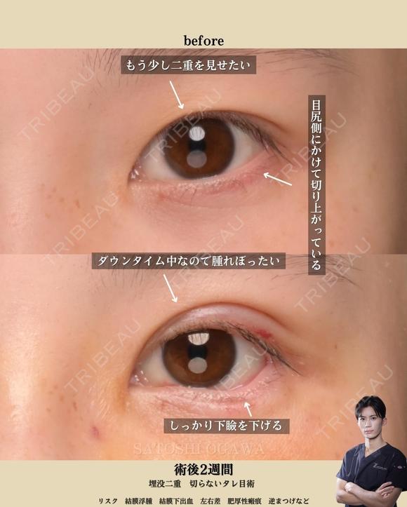 埋没二重と切らないタレ目術を受けられた方です。 14日後 メイン用