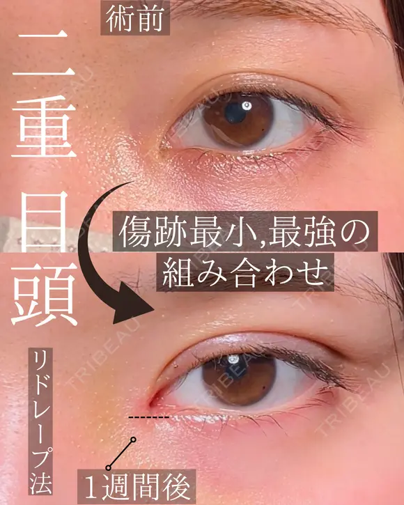 目頭切開　二重埋没 after画像 メイン用