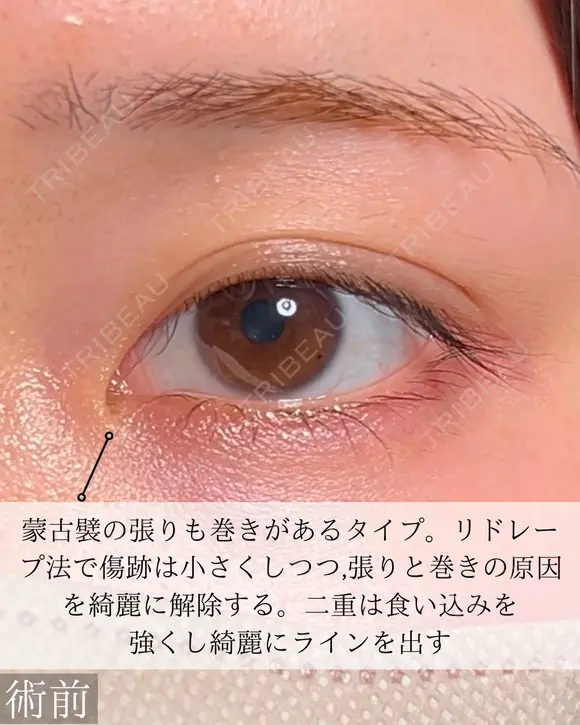 目頭切開　二重埋没 before画像 メイン用