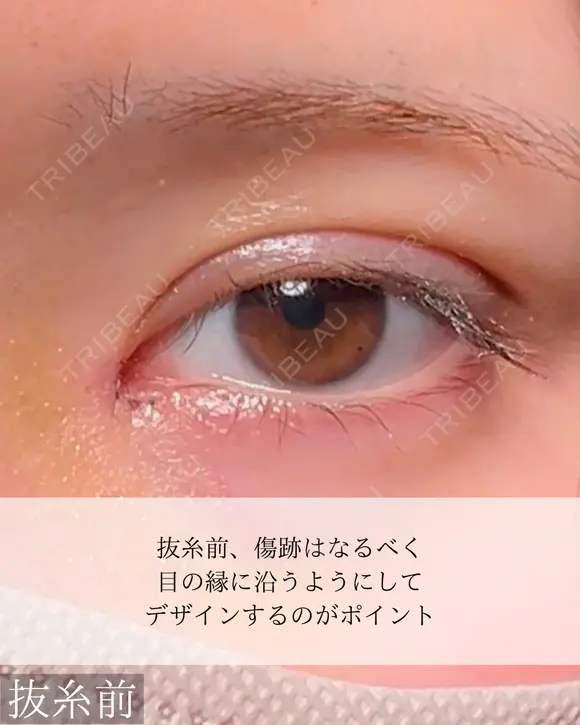 目頭切開　二重埋没 after画像 メイン用