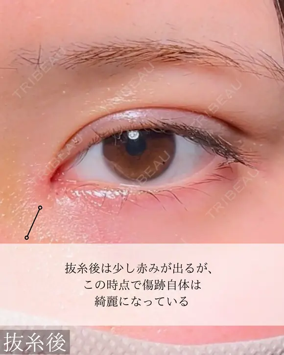 目頭切開　二重埋没 after画像 メイン用
