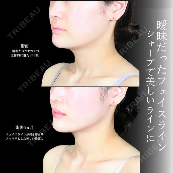 頬・顎下脂肪吸引/ジョールファット/バッカルファット/エラボトックス/糸リフト before画像 メイン用