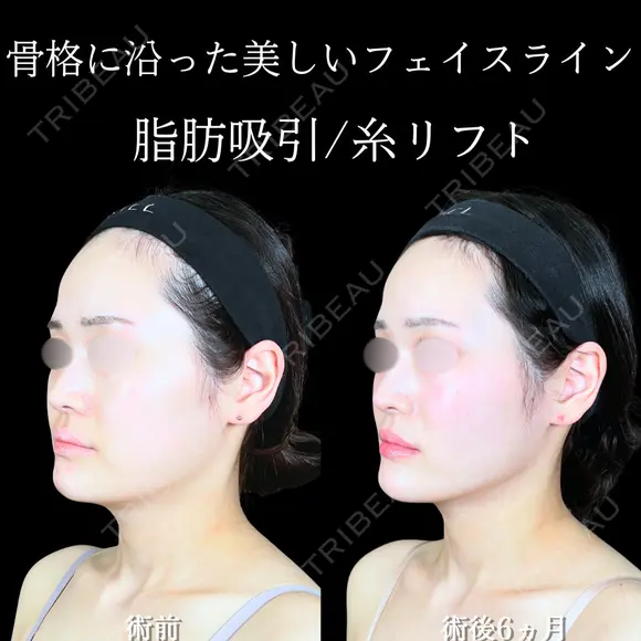 頬・顎下脂肪吸引/ジョールファット/バッカルファット/エラボトックス/糸リフト 180日後 メイン用