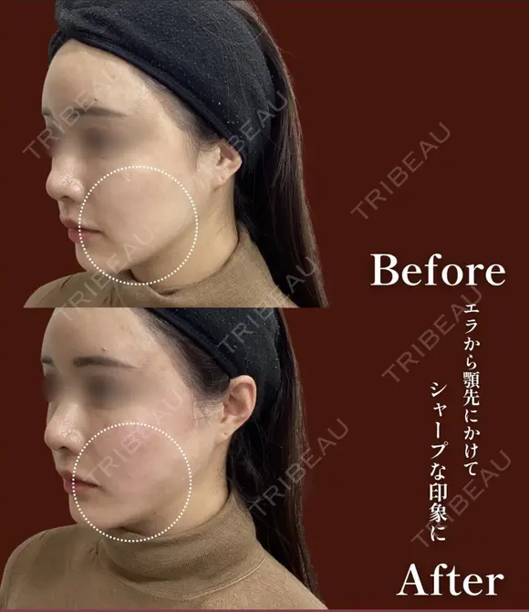スレッド（糸）リフト before画像 メイン用