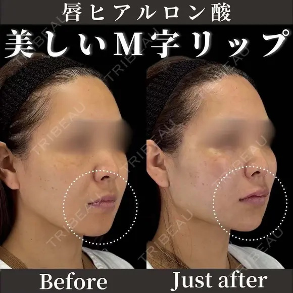 唇ヒアルロン酸 before画像 メイン用
