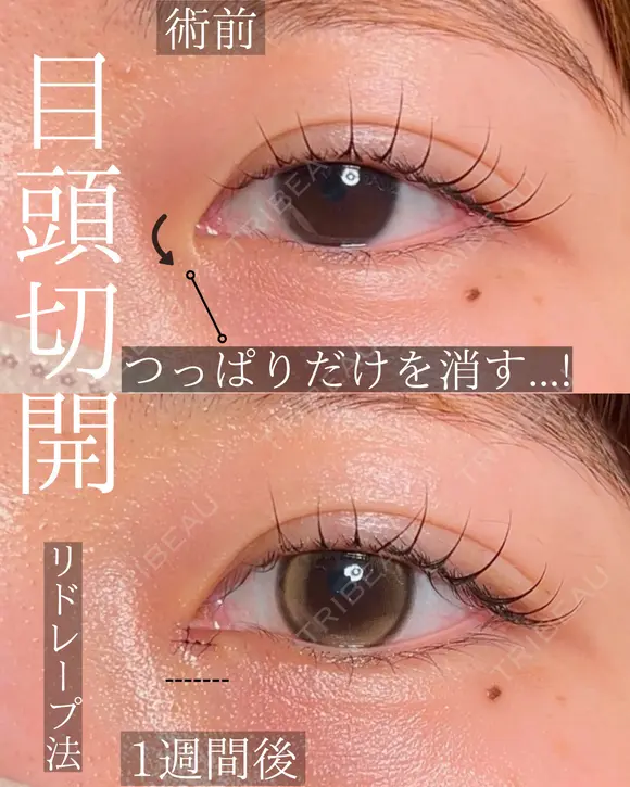 目頭切開 after画像 メイン用