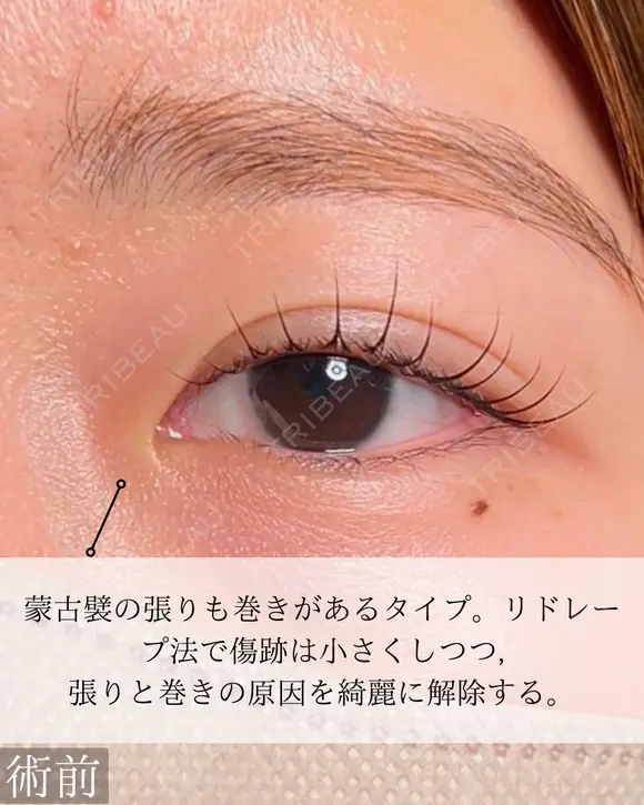 目頭切開 before画像 メイン用