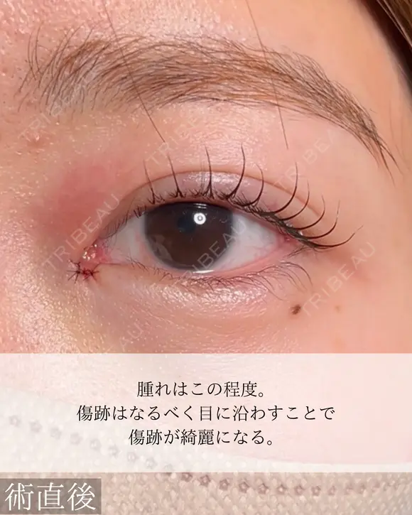 目頭切開 after画像 メイン用