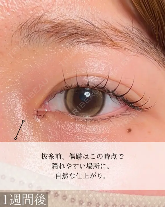 目頭切開 after画像 メイン用