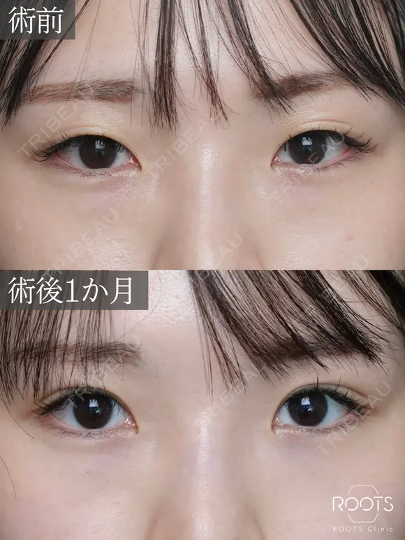 二重埋没　裏シークレットダブルループ before画像 メイン用
